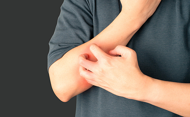 Ekzém mě provází celým mým životem. Pomohla mi biologická léčba